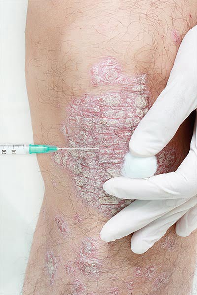 injected-psoriasis-medications-img