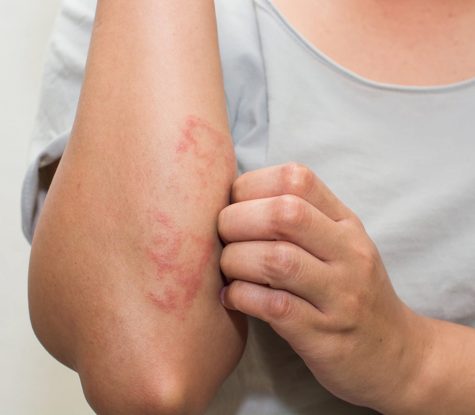 symptoms-of-atopic-dermatitis-img Atopic Dermatitis Treatment Plan