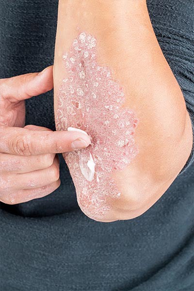 wdc-topical-soriasis-treatments-img
