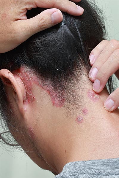 what-is-psoriasis-disease-img