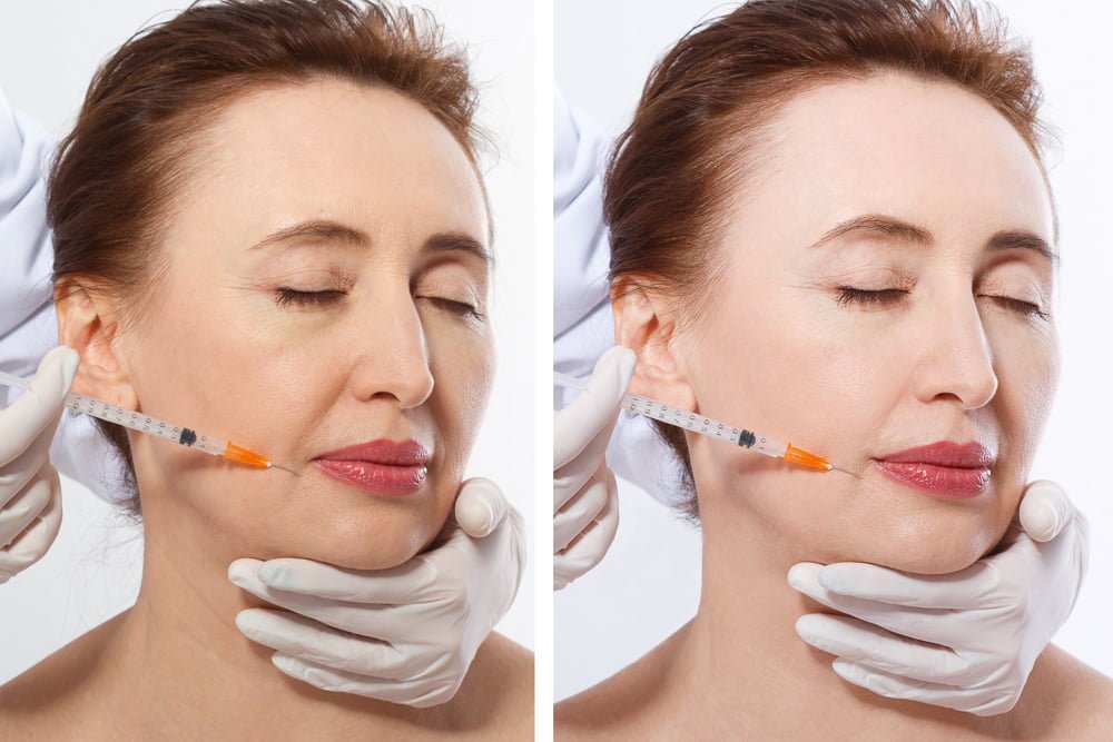 How can dermal filler injections benefit you?