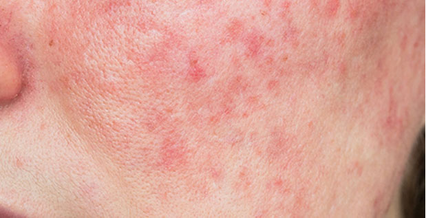 What is Rosacea?