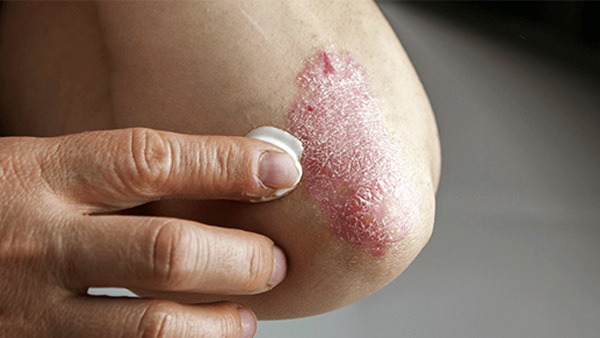 Psoriasis Treatment at Wilmington Dermatology