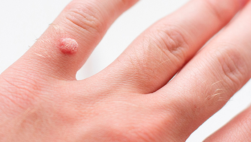 What Are Warts?