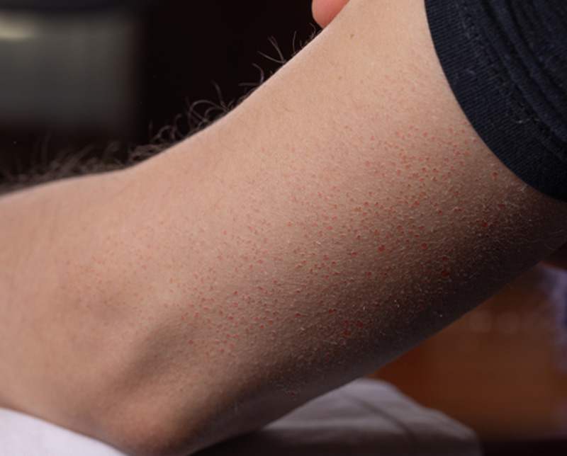 What is Keratosis Pilaris?