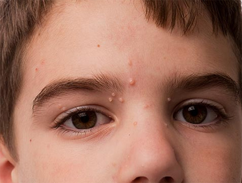 What is Molluscum?