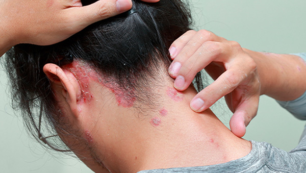 What is Psoriasis?