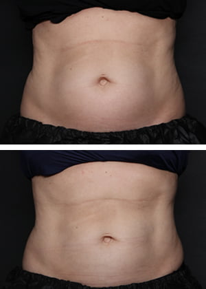 CoolSculpting Before and After