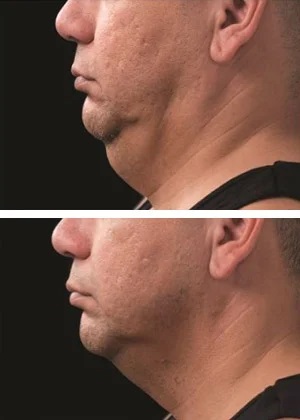 CoolSculpting Before and After at WDC