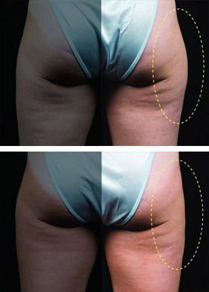 CoolSculpting Before and After at Wilmington Dermatology Center