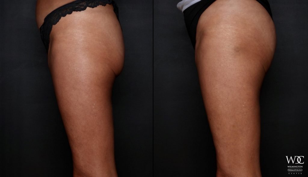 Cooltone Before and After