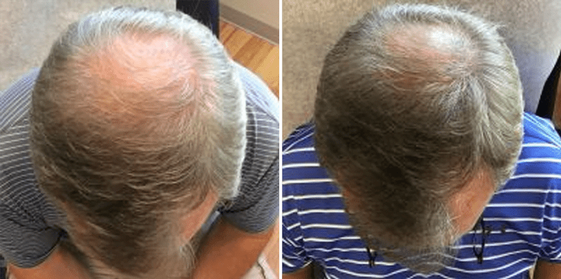 Hair Loss Treatments Before and After Hair Loss Treatments Before and After
