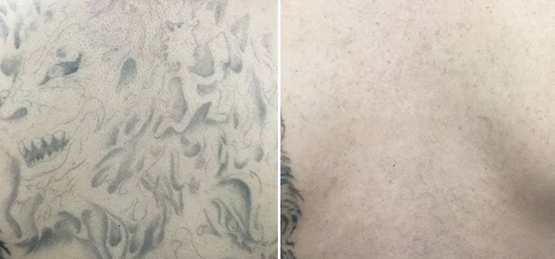 Tattoo Removal in Wilmington