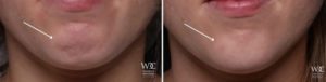 BOTOX