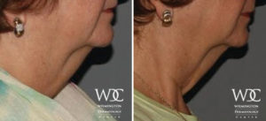 KYBELLA