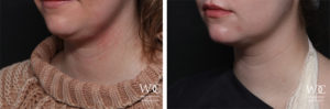 KYBELLA