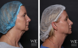 KYBELLA