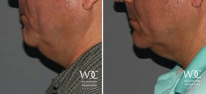 COOLSCULPTING ELITE