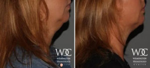 COOLSCULPTING ELITE