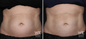 COOLSCULPTING ELITE
