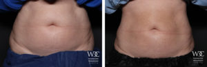 COOLSCULPTING ELITE