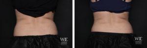 COOLSCULPTING ELITE