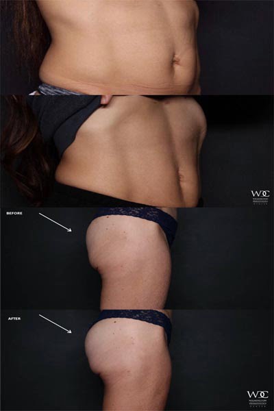wilmington-cooltone-muscle-toning (1)