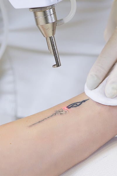 wilmington-tattoo-removal (1)
