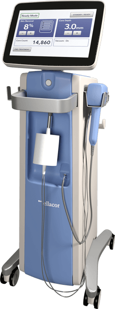 ellacor® Micro-Coring™ Technology at WDC