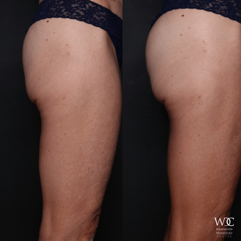 Cooltone Before and After