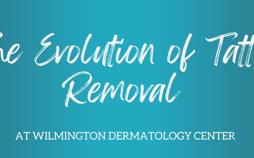 Tattoo Removal